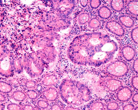 Adenocarcinoma In Human Colon Light Micrograph Stock Image C0558254 Science Photo Library