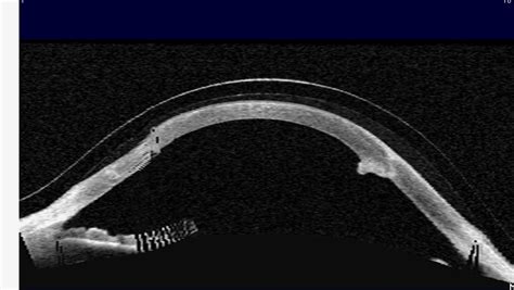 Visante Optical Coherence Tomography