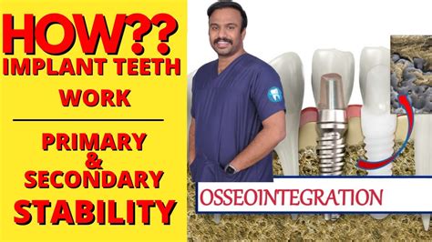 How Implant Work Osseointegration Primary And Secondary Stability