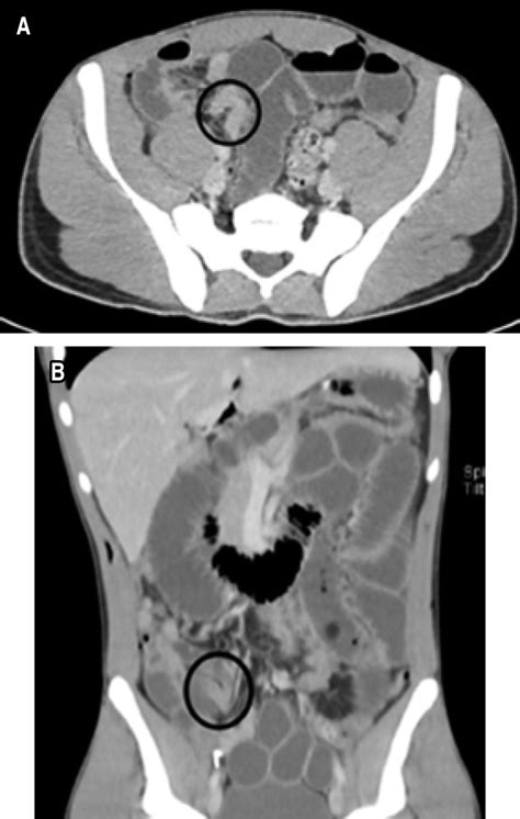 Internal Small Bowel Hernia Through A Peritoneal Defect After Inguinal Hernia Repair With Tapp