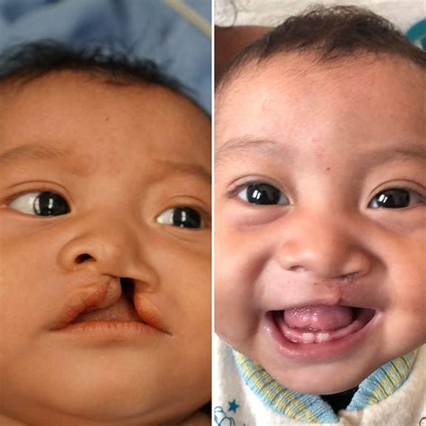 Albums 99 Pictures Cleft Palate Before And After Pictures Completed