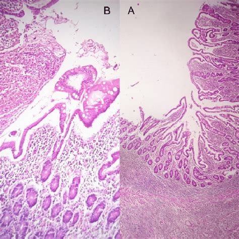 Both Of A Biopsy From The Fourth Duodenal Segment And B Biopsy From