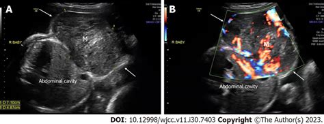 Prenatal Ultrasonic Imaging Of The Congenital Hemangioma Of The