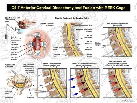 Female C Anterior Cervical Discectomy Utilizing Traction And Fusion