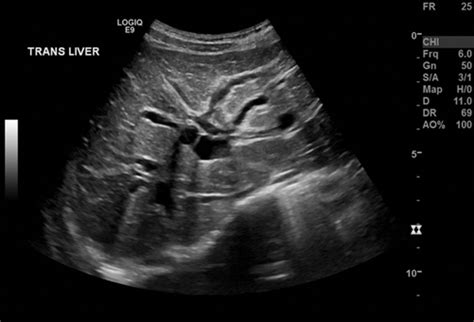 Common Bile Duct Ultrasound