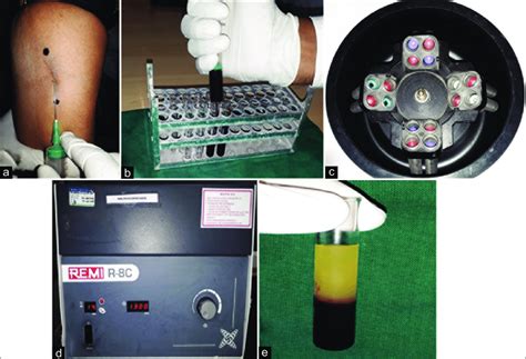 Preparation Of Modified Advanced Platelet Rich Fibrin Clot A