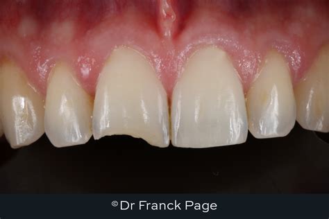 Aesthetic Composite Resin Restorations Dental Implants