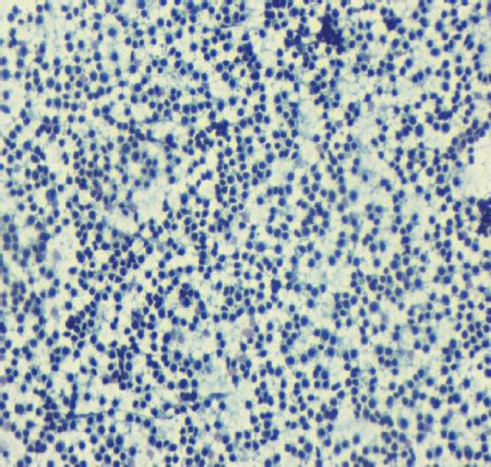 Cytology smear of small lymphocytic lymphoma showing small cells with ...