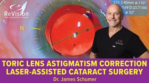 Toric Intraocular Lens Placement During Laser Assisted Cataract Surgery