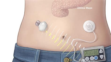 Tecnología para controlar la diabetes CNN Video