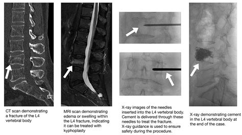 Kyphoplasty - Mecklenburg Radiology Associates