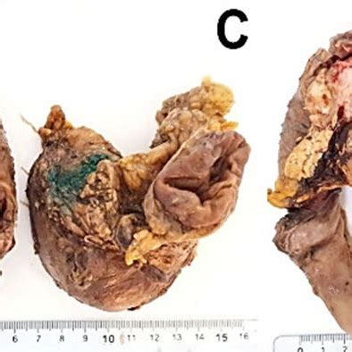 A E The Macroscopic Appearance Of The Surgically Resected Specimen