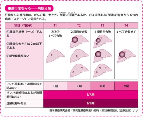 肝臓がんの治療方針、治療の特徴は？進行度と治療法の選択は？ がんプラス