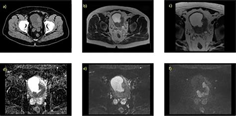 Frontiers Mr Guided Adaptive Radiotherapy For Bladder Cancer