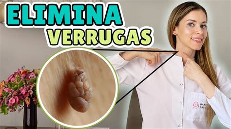 Elimina Verrugas Del Cuello Verrugas En El Cuello Nunca M S C Mo