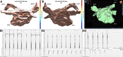 Prospective Star Guided Ablation In Persistent Atrial Fibrillation