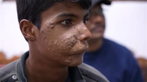 Boy With A Large Hemangioma In Face Complete 8 Days Treatment Surgery