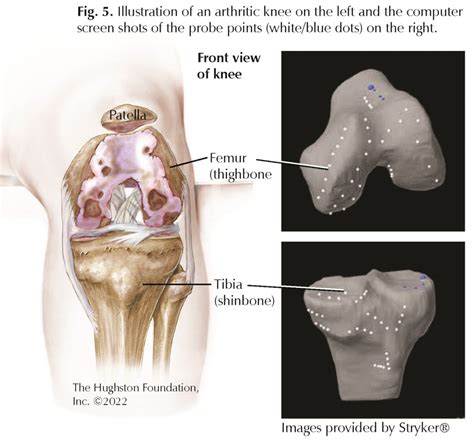 Robotic Total Knee Replacement Questions For A Specialist Hughston