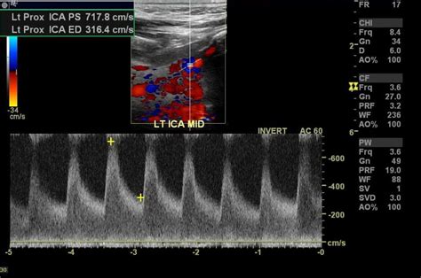 Vertebral Carotid Duplex Scan