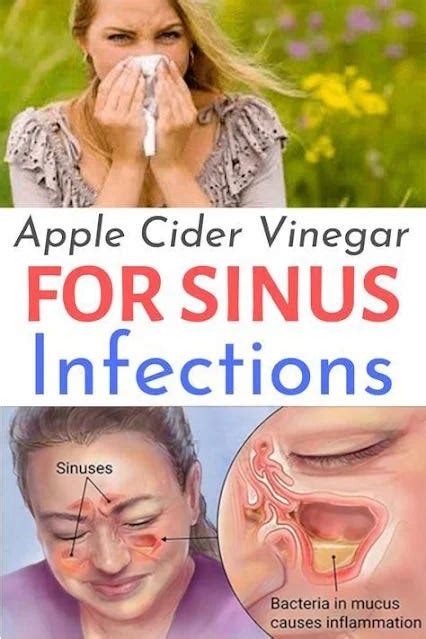 How To Kill Sinus Infection Within Minutes With Apple Cider Vinegar Mary Odonnell Medium