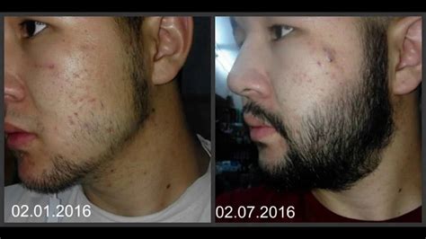 Rogaine Beard Before And After Pictures