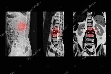 Resonancia magnética de la columna lumbar Antecedentes de caída con