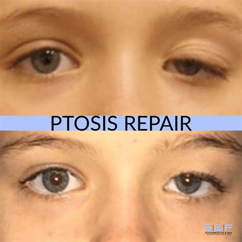 Ptosis Surgery Long Island Droopy Eyelid Treatment Long Island