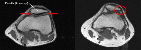 Patellofemoral Pain Syndrome Pfps Motus Physical Therapy