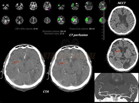 CT perfusion (CTP) | STROKE MANUAL