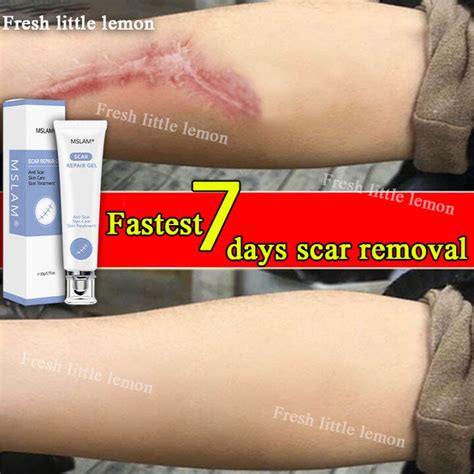 Days Fast Scar Removal Mslam Scar Removal Cream Repairing Surgical