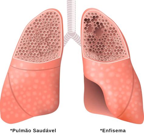 O que é Enfisema Pulmonar tratamento sintomas diagnóstico e perigos