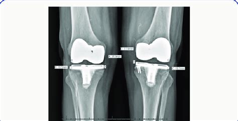 Measurements Performed On Anteroposterior View X Rays Download Scientific Diagram