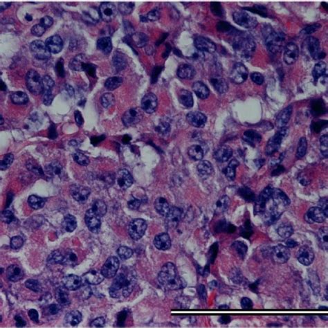 Tumor Cells With Synaptophysin Positivity Are Diffusely Present Arrow