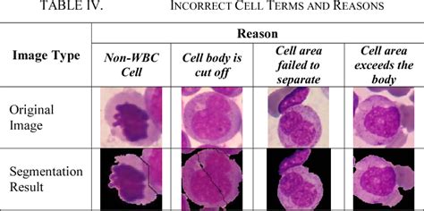 Figure 4 From Classification Of Cell Types In Acute Myeloid Leukemia Aml Of M4 M5 And M7