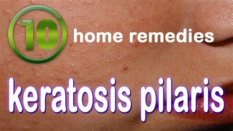 10 Home Remedies For Keratosis Pilaris Natural Treatment For