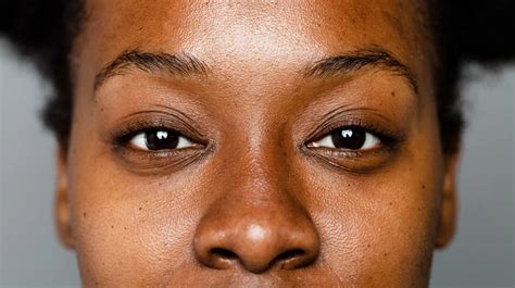 Hyperpigmentation On Black Skin