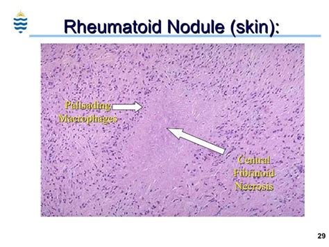 Pathology Of Arthritis