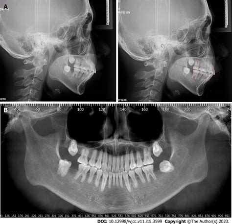 Posttreatment Lateral Cephalometric And Cone Beam Computed Tomography