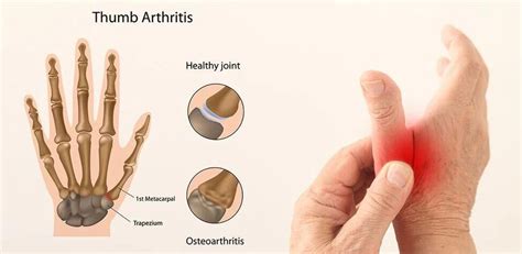 Thumb Arthritis: Symptoms, Causes, Treatment By WristT & Thumb Braces