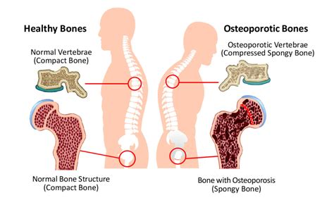 Osteoporosis Ways To Reduce Your Risk Simply Health Wellness