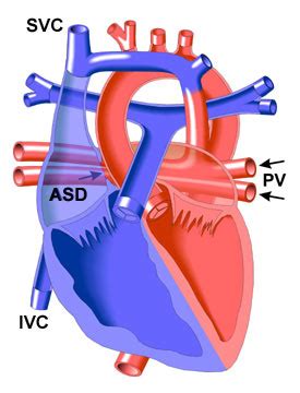 Congenital Defects Tutorial Congenital Heart Defects Atlas Off