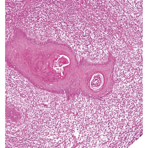 Dissecting Cellulitis Of The Scalp A Inflamed Granulation Tissue And Download Scientific