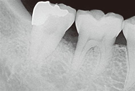 Initial Intraoral Periapical Radiograph Of The Lower Right First And