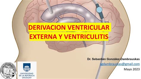 Derivaciones Ventriculares Externas Y Ventriculitis Complicaciones Y