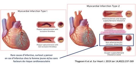 Cours Syndrome Coronarien Aigu Flashcards Quizlet