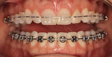 Ceramic Braces - Peninsula Orthodontics