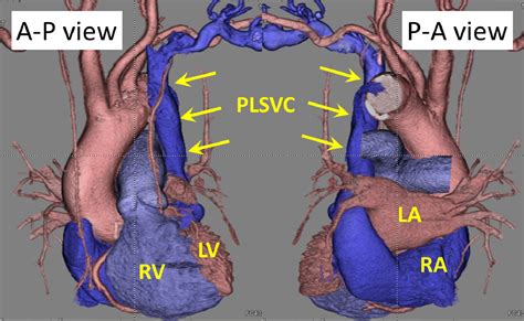 Permanent Pacemaker Implantation In A Patient With Persistent Left