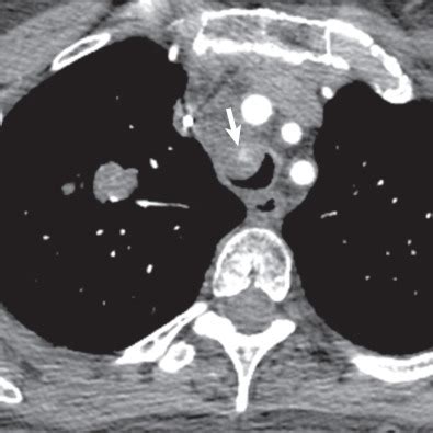 Pulmonary Metastases | Radiology Key