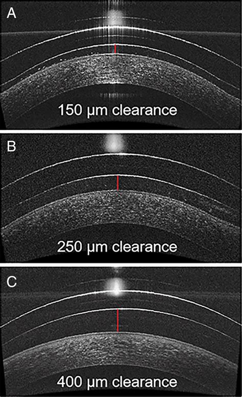 Optical Coherence Tomography And Scleral Contact Lenses Clinical And