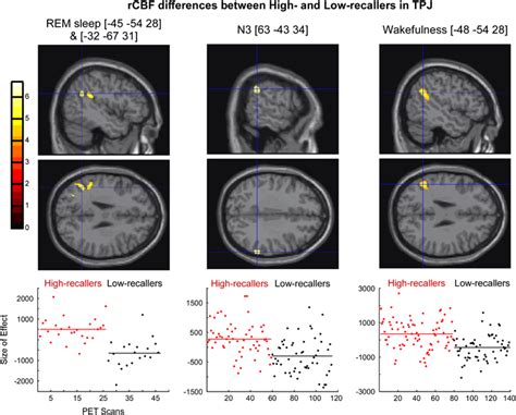 Regional Cerebral Blood Flow Rcbf Differences In Temporoparietal